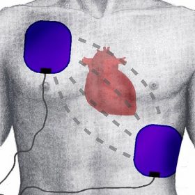positie elektroden AED reanimatie