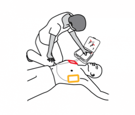 schok toedienen AED