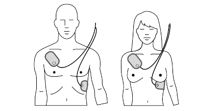 positie elektroden AED